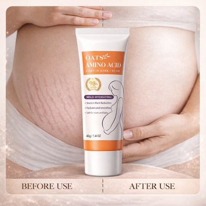 Stretch Marks Cream
